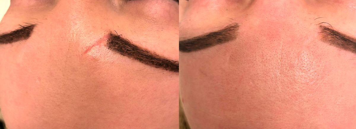 Лазерное удаление шрамов