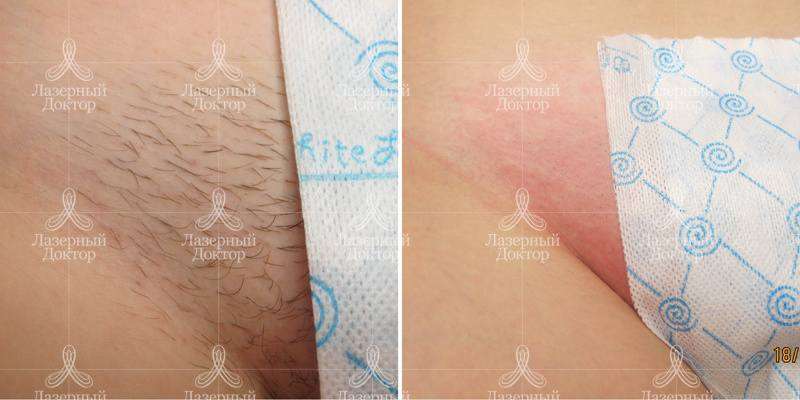 Лазерная эпиляция глубокого бикини (фото)