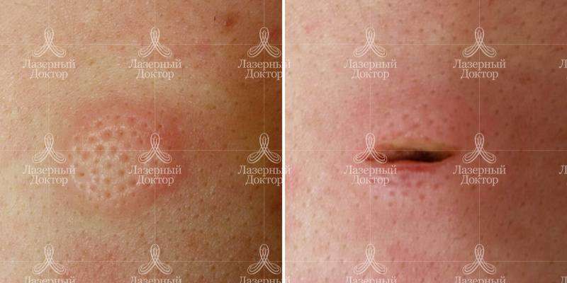 Лазерное удаление атеромы на теле