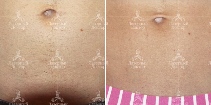 Мотус эпиляция живота (фото до и после)