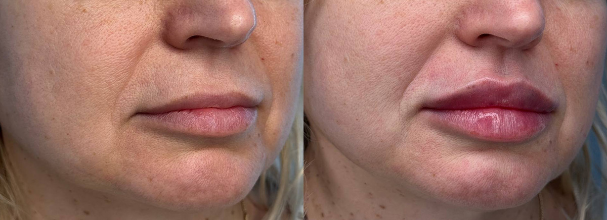 Контурная пластика губ 