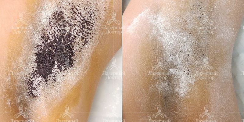 гипергидроз