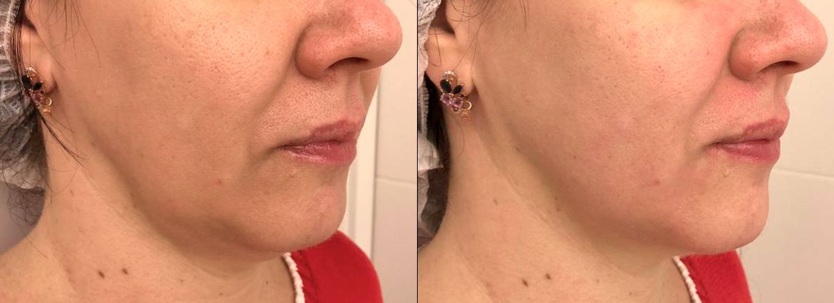 SMAS-лифтинг ULTRAFORMER