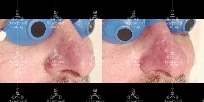 удаление гемангиомы