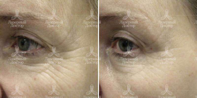 Волюмизация (фото)