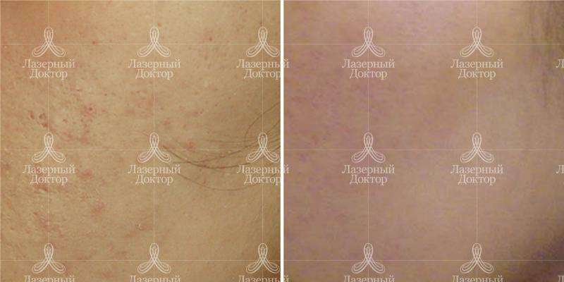 Карбоновый лазерный пилинг (фото)