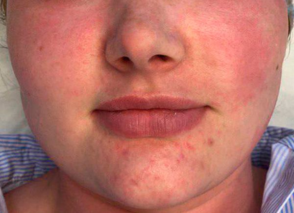 биоревитализация до