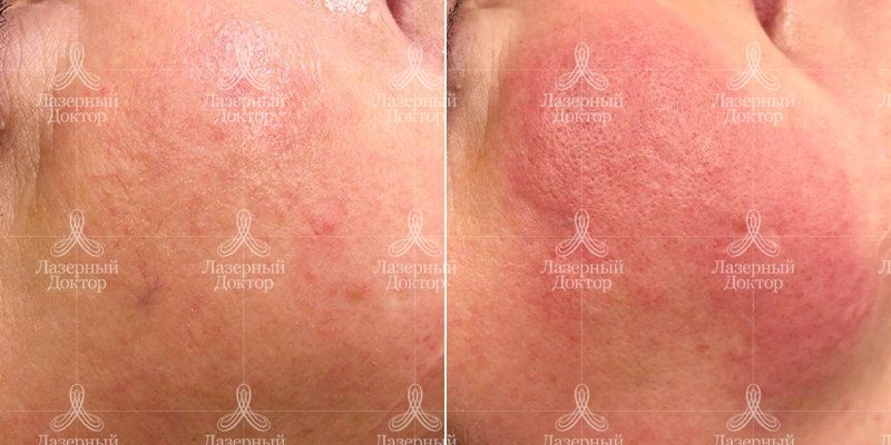 IPL-фотолечение Quantum