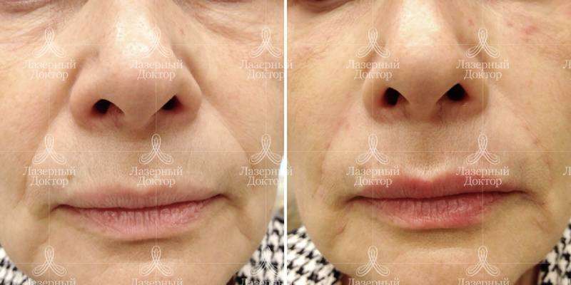 Контурная пластика носогубных складок