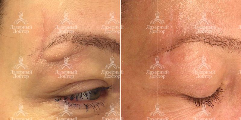 Удаление шрамов