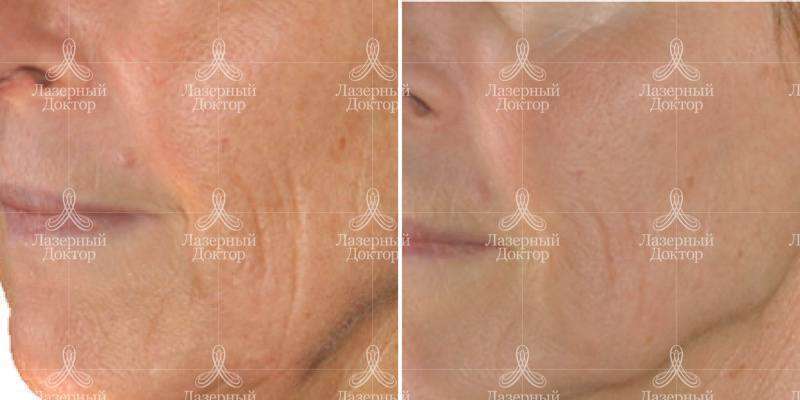 Игольчатый лифтинг infini 3d lift