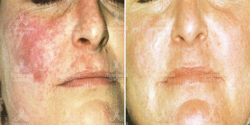 Фотолечение лица (отзывы, фото)
