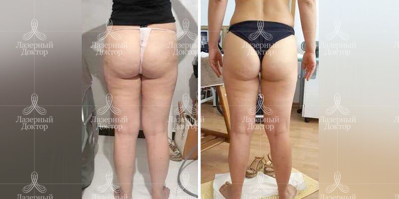 эндосфера терапия или криолиполи