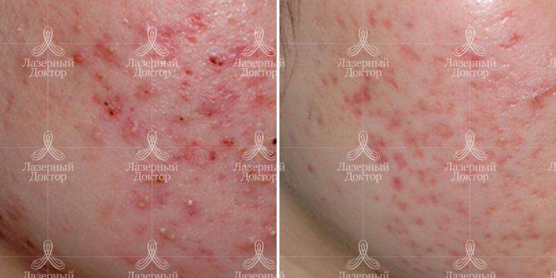 На фото вы видите результат лечения акне лазером.