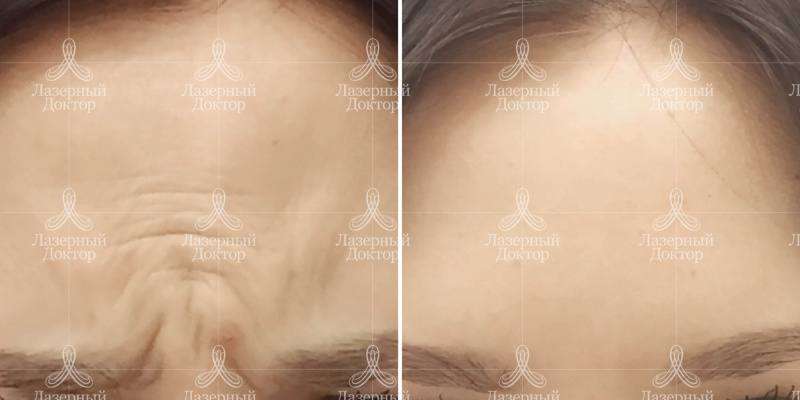 Фото результата инъекций Ботокса в межбровье