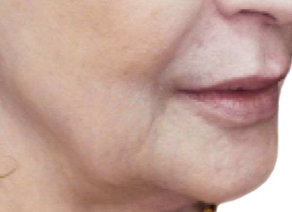 3D-волюмизация 