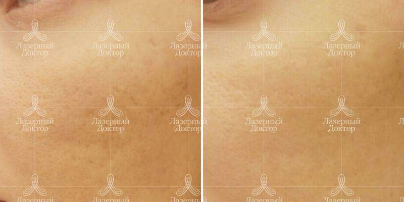 Удаление шрамов: до и после фото