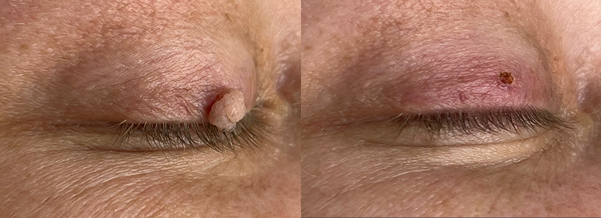 удаление папилломы