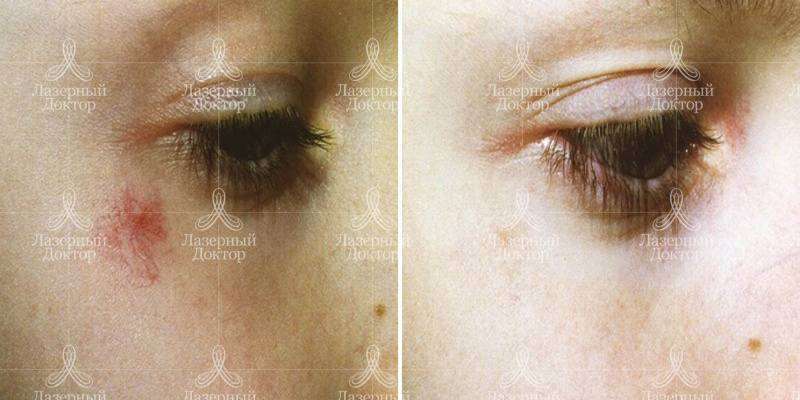 Фотоомоложение Quantum (фото до и после)