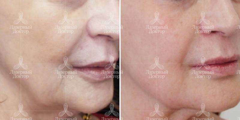 волюмизация лица (фото)