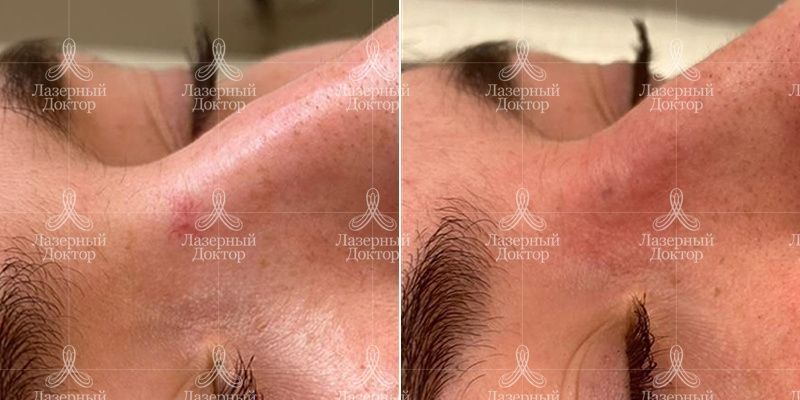 удаление новообразований