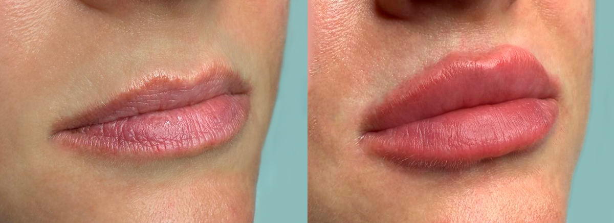 Контурная пластика губ Art Filler