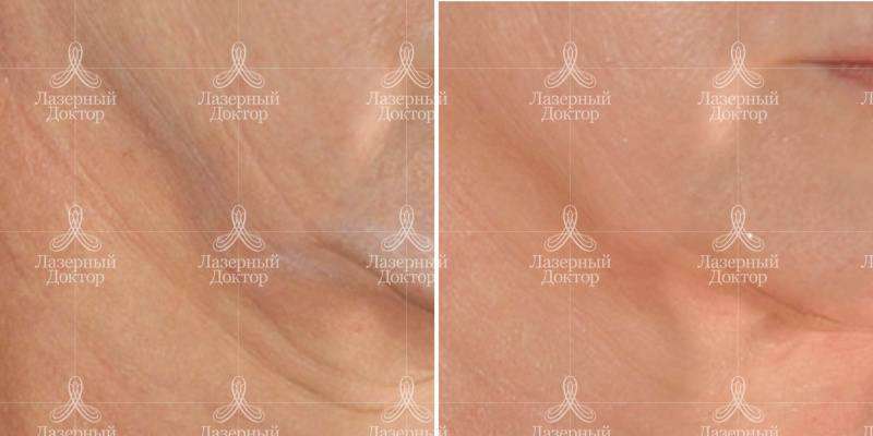 3d лифтинг (аппарат infini)