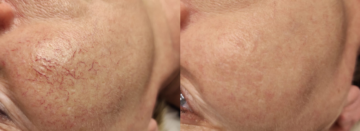 IPL-фотолечение Quantum 