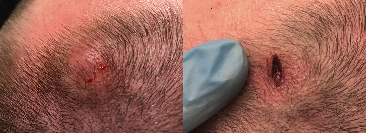 удаление новообразования