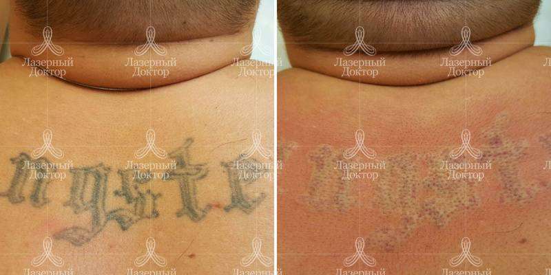 Сведение тату: до и после