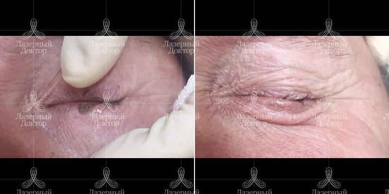 кератома до и после