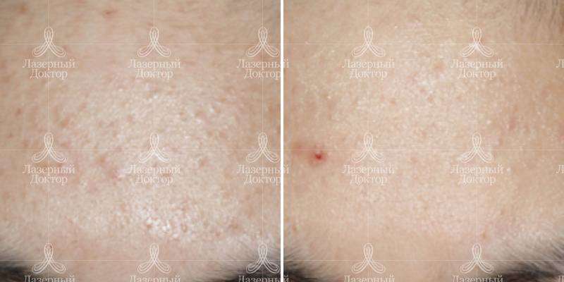 Лечение акне в клинике