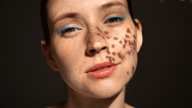 Пигментные пятна на лице: виды, причины появления, как избавиться от пигментации