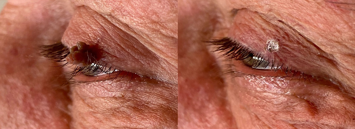 удаление папилломы