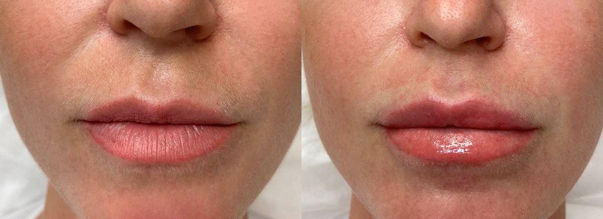 Контурная пластика