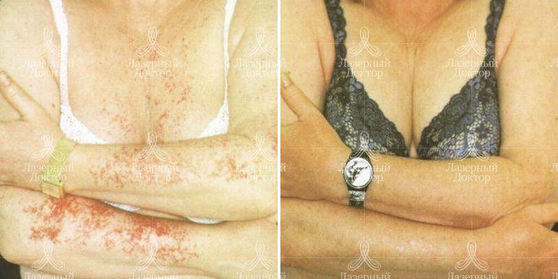 Фототерапия - это?