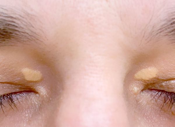 Удаление новообразований фото до и после