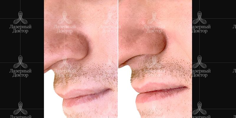 удаление сосудов