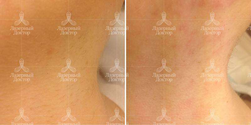 Лазерная эпиляция шеи