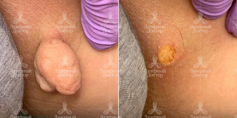 Удаление фибролипомы