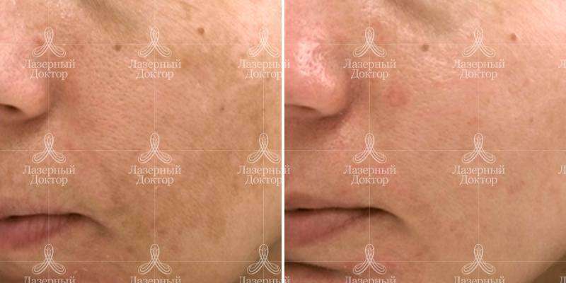 Удалить пигментные пятна (фото до и после)