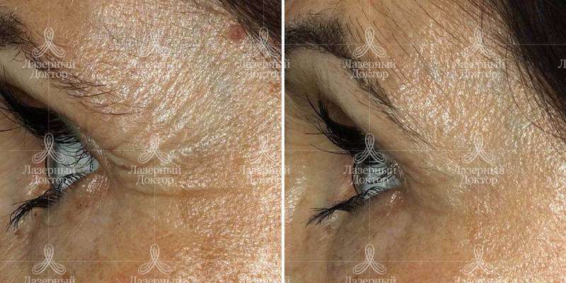 Фраксель: отзывы, фото