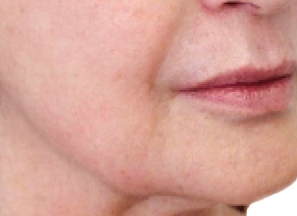 3D-волюмизация 