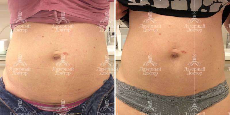 Интралипотерапия - что это? (фото)