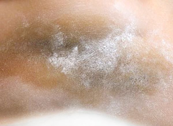 Лечение гипергидроза фото до и после