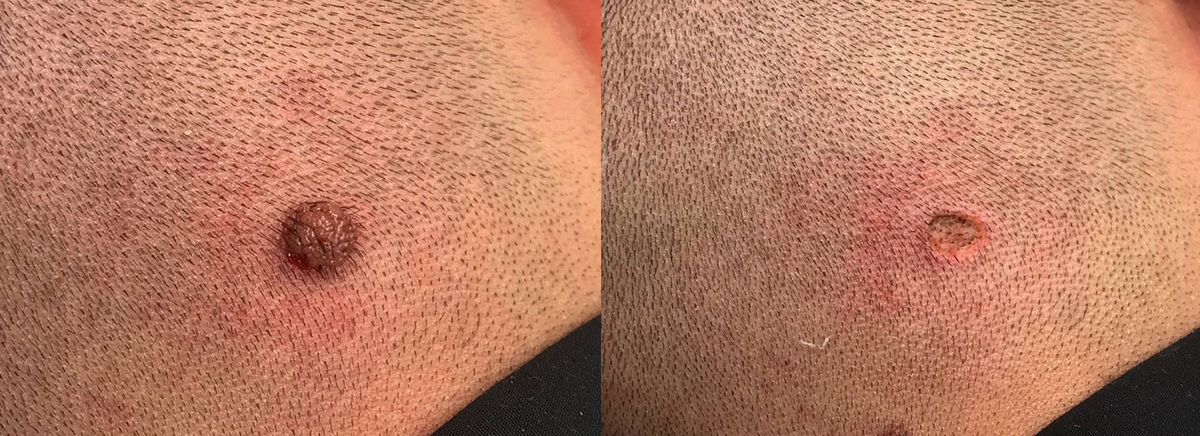 удаление новообразования