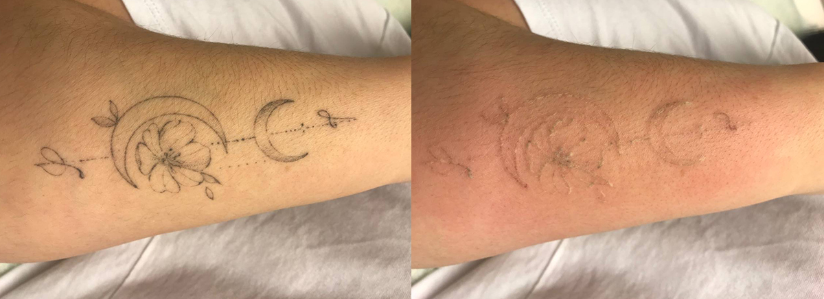 Удаление татуировок 