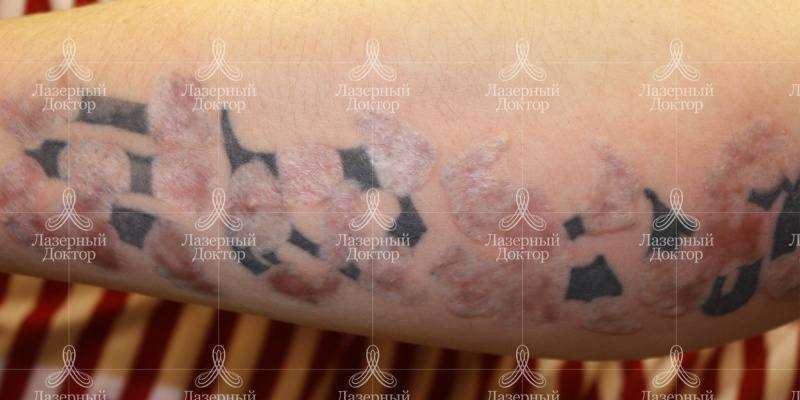 Фото после лазерного удаления тату