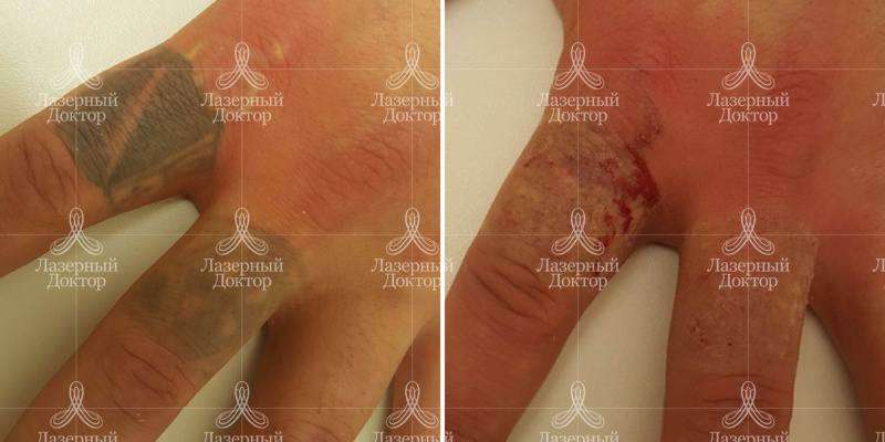 Удаление тату лазером (фото)
