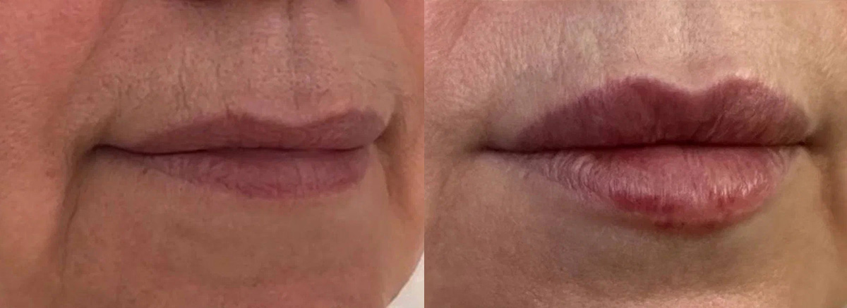 Контурная пластика носогубных складок